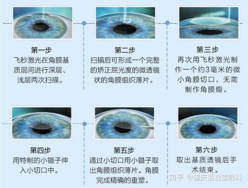 激光手術飛秒和全準激光的區(qū)別,激光手術飛秒與全準激光的區(qū)別及快速響應方案落實探討,穩(wěn)定性設計解析_V223.80.25