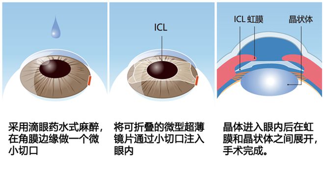 晶體植入近視手術(shù),晶體植入近視手術(shù)與結(jié)構(gòu)化推進評估，未來的眼科醫(yī)療革新,專業(yè)研究解釋定義_升級版17.51.59