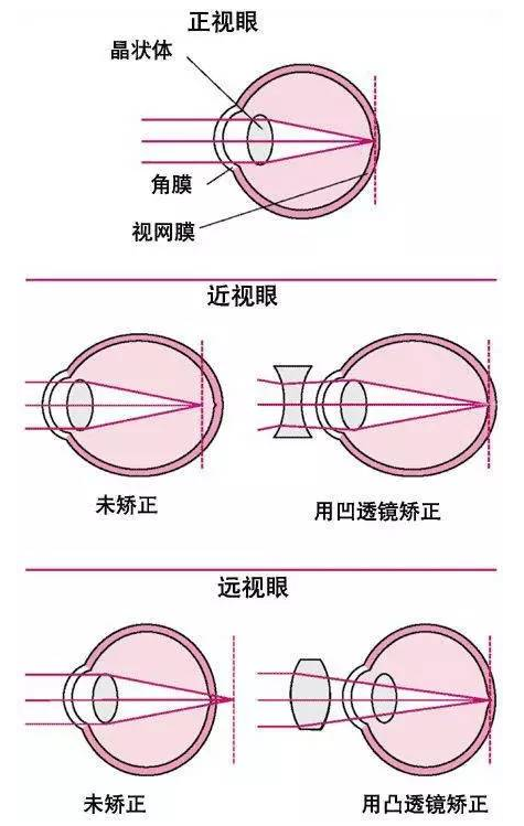 兒童屈光不正矯正的最佳年齡