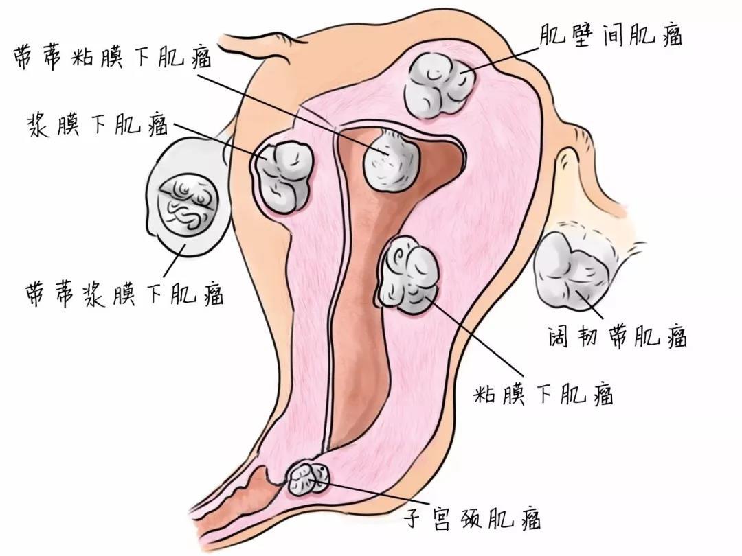 子宮肌瘤咨詢免費(fèi)專家,子宮肌瘤咨詢免費(fèi)專家，深度解析與數(shù)據(jù)執(zhí)行研究,創(chuàng)新策略解析_云端版21.84.98