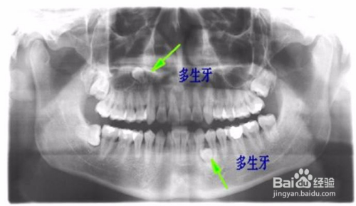 多生牙拔除大概需要多少費(fèi)用