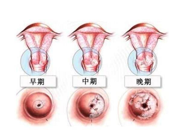 多數(shù)人感染HPV后兩年內(nèi)可自愈